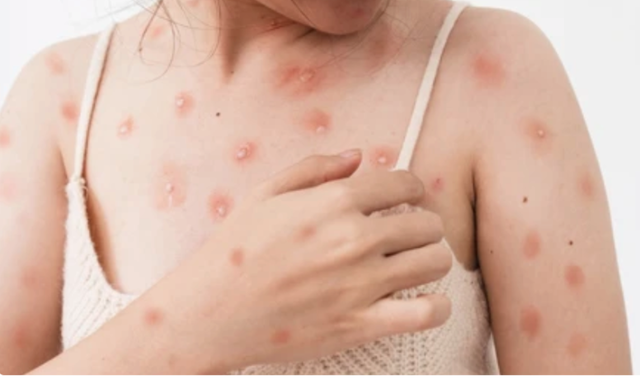 Đậu mùa khỉ ở TP.HCM có dễ lây không? - Ảnh 1.
