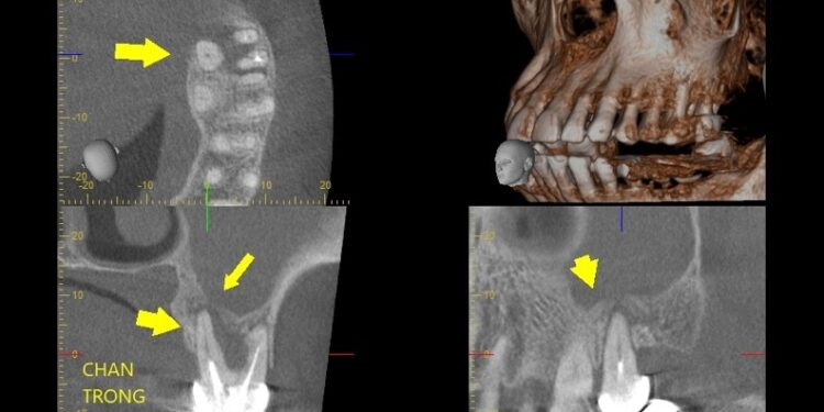 Viêm xoang hàm do răng: Nguyên nhân và phương pháp điều trị