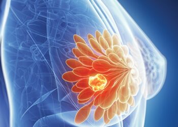 Sàng lọc, chẩn đoán sớm ung thư vú