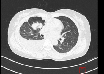Ca lâm sàng: Điều trị ung thư phổi không tế bào nhỏ giai đoạn di căn xa bằng thuốc đích