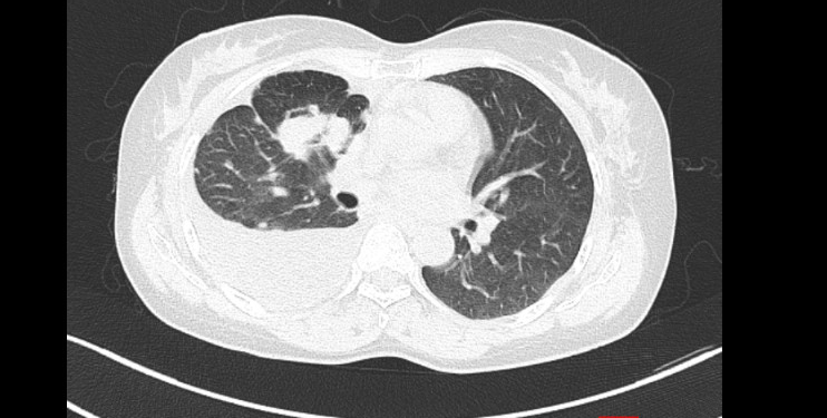 Ca lâm sàng: Điều trị ung thư phổi không tế bào nhỏ giai đoạn di căn xa bằng thuốc đích