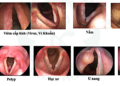Rối loạn giọng nói: Nguyên nhân và phương pháp điều trị