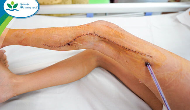 Bé gái 9 tuổi đã nhiều năm đau đớn, không đi lại được vì chân có khối dị dạng tĩnh mạch