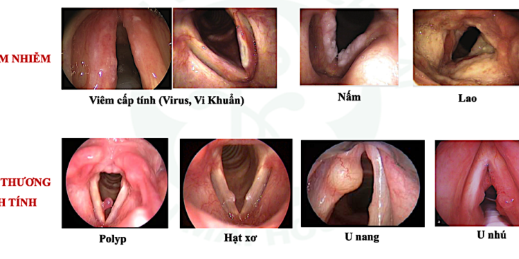 Rối loạn giọng nói: Nguyên nhân và phương pháp điều trị