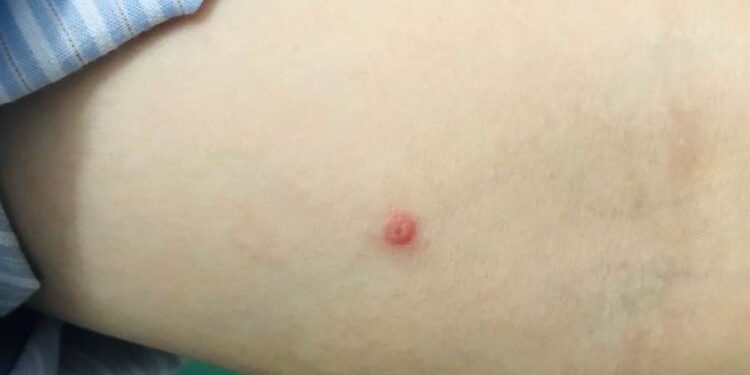 Bệnh nhân đậu mùa khỉ đầu tiên ở TP.HCM hiện ra sao?