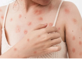 Đậu mùa khỉ có dễ lây không?