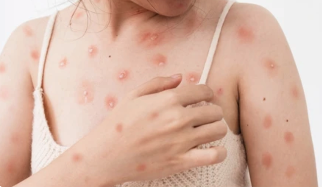 Đậu mùa khỉ có dễ lây không?