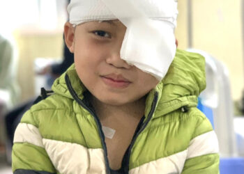 Cậu bé 8 tuổi người dân tộc Dao với u máu khủng ở mắt được điều trị ổn định