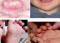 Vì sao bệnh tay chân miệng có khả năng tái phát và nguy hiểm?