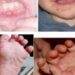 Vì sao bệnh tay chân miệng có khả năng tái phát và nguy hiểm?