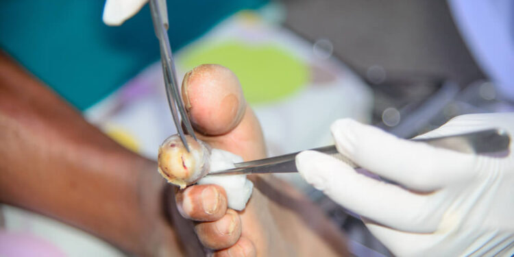 Hiệu quả của phương pháp Làm sạch vết thương cơ học đơn giản