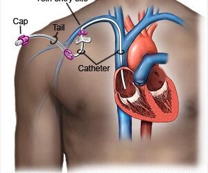 📊Bắt được mảnh gãy Catheter trung tâm sau 10 năm, có nên hay không?