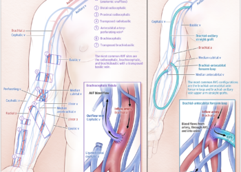 Tiếp cận cầu nối động tĩnh mạch trong chạy thận nhân tạo JAMA 2024