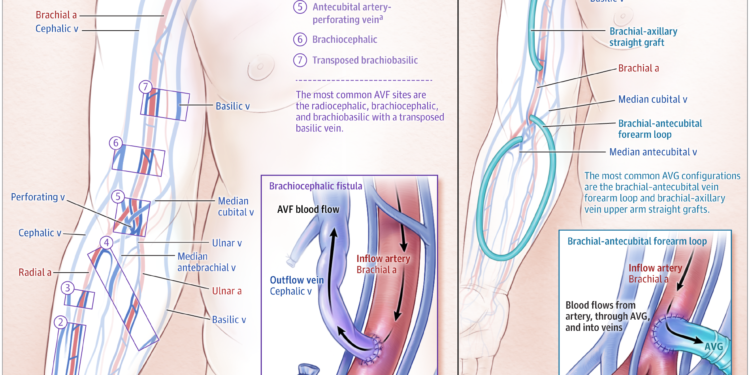 Tiếp cận cầu nối động tĩnh mạch trong chạy thận nhân tạo JAMA 2024